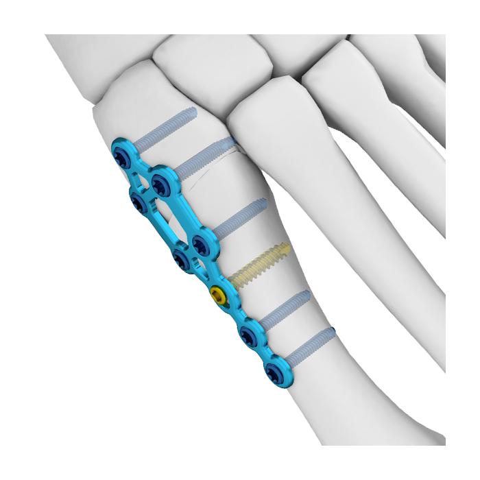 Mini Locking Plate Ankle Foot Locking Cortex Screw Fusion Locking Plate