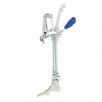 Надколенный штифт SPTN,Производители медицинского