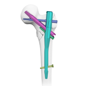 proximal femoral compression nail