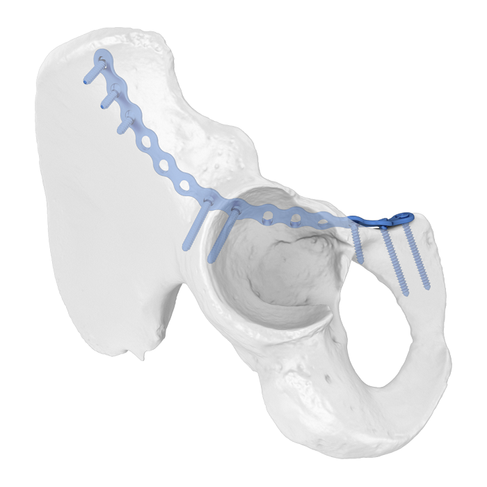 Система гибкой вертлужной пластины (FAP) Подвздошно-лобковая передняя колонна Анатомическая фиксирующая пластина
