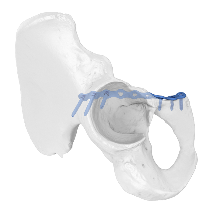 Система гибкой ацетабулярной пластины (FAP) Подвздошно-лобковая передняя линия Анатомическая фиксирующая пластина
