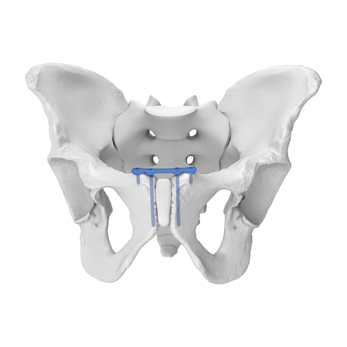 Система гибкой вертлужной пластины (FAP) Верхний симфиз лобкового анатомического фиксатора
