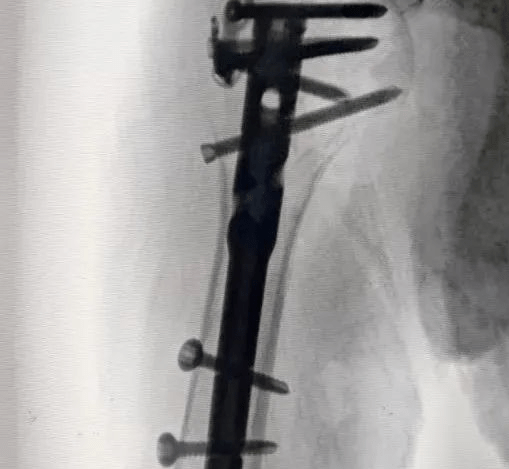 Обмен случаями: первый интрамедуллярный штифт с шариком плечевой чашки для перелома проксимального отдела плечевой кости в Китае