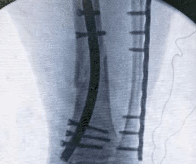 Деловой случай: перелом дистального отдела большеберцовой кости