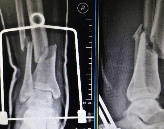 Деловой случай: перелом дистального отдела большеберцовой кости