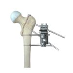 Pertrochanteric External Fixator
