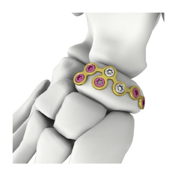 Itval Navicular Locking Plate — Блокируемая пластина для ладьевидной кости Itval