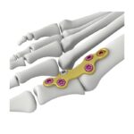 Itval MTP Fusion Locking Plate — Блокируемая пластина для артродеза MTP Itval
