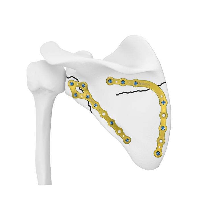 Медиальная блокируемая пластина лопатки