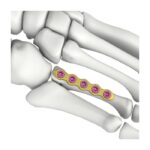 Itval Straight Locking Plate — Прямая блокируемая пластина Itval